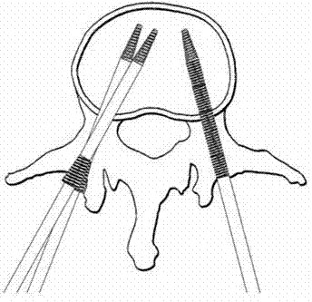 微创椎弓根植骨支撑钉的制造方法与工艺