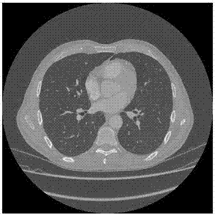 一種從胸部CT圖像中提取肺血管的方法及裝置與流程
