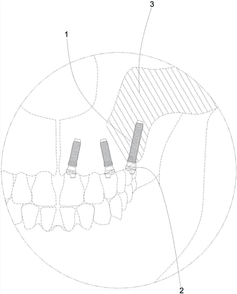 翼骨结节复合体用倾斜式植牙结构的制造方法与工艺
