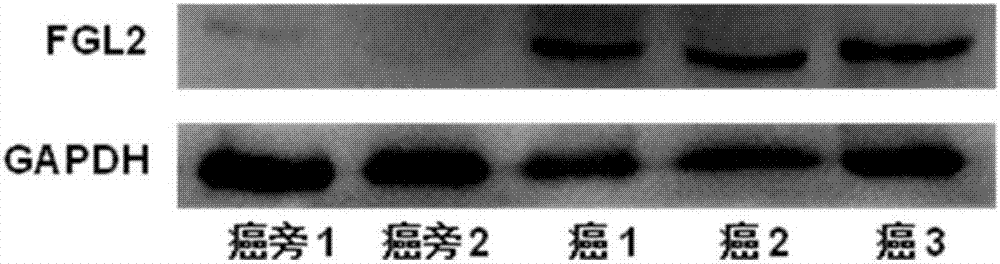 檢測FGL2基因或FGL2蛋白表達水平的物質(zhì)在診斷和預(yù)示腎癌產(chǎn)品中的應(yīng)用的制造方法與工藝