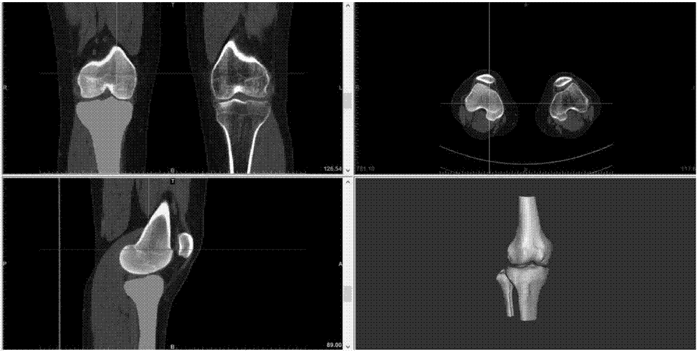 一种膝关节盘状半月板模拟手术方法与流程