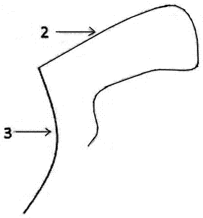 關(guān)胸手術(shù)縫合裝置的制造方法