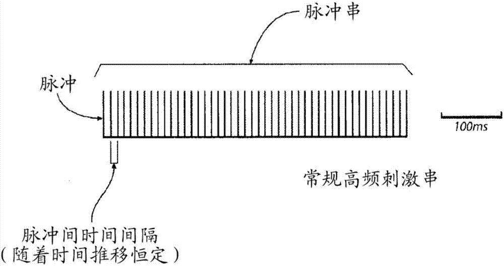 用于治療神經(jīng)紊亂的非規(guī)律電刺激模式的制作方法與工藝