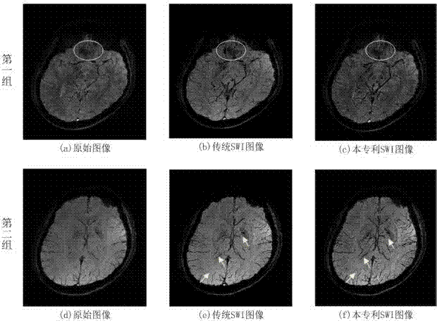 一种磁共振磁敏感加权成像后处理方法及系统与流程