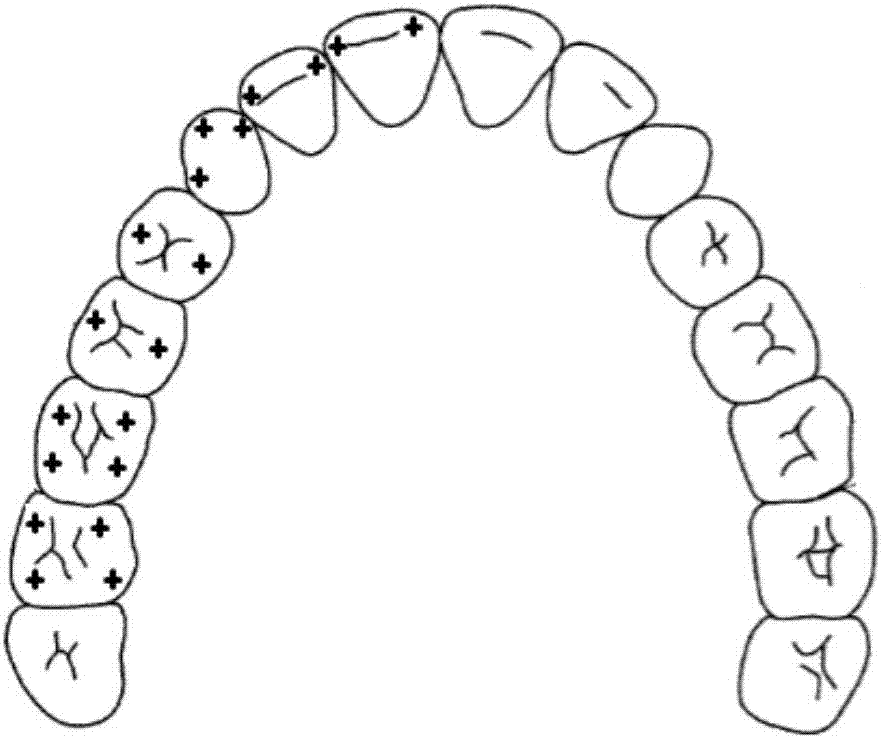 一种基于人工智能的牙列畸形自动化分类和设计方法与流程