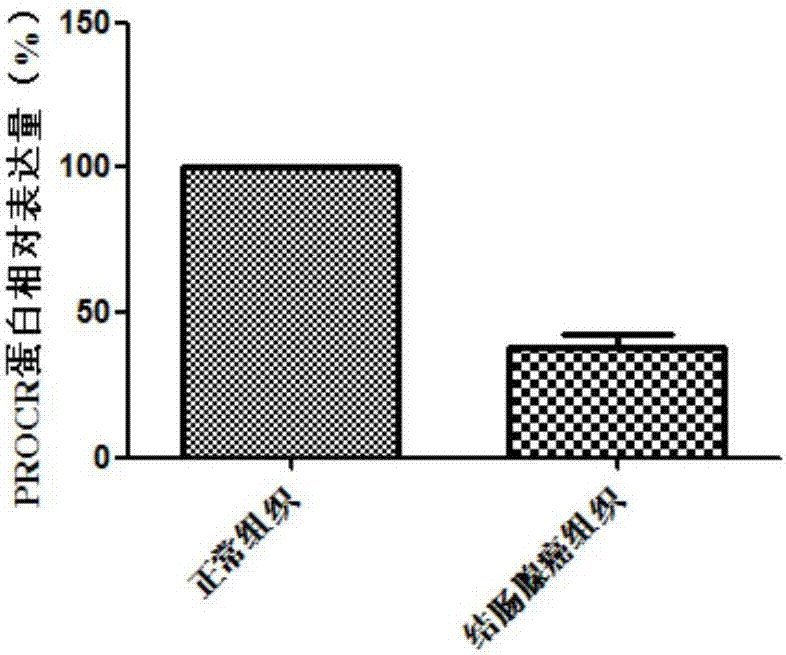 結(jié)腸腺癌診治標(biāo)志物的制作方法與工藝