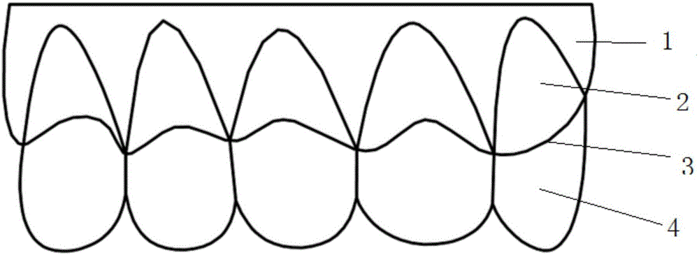 正畸用牙齒三維數(shù)字化優(yōu)化結(jié)構(gòu)模型的生成方法與流程