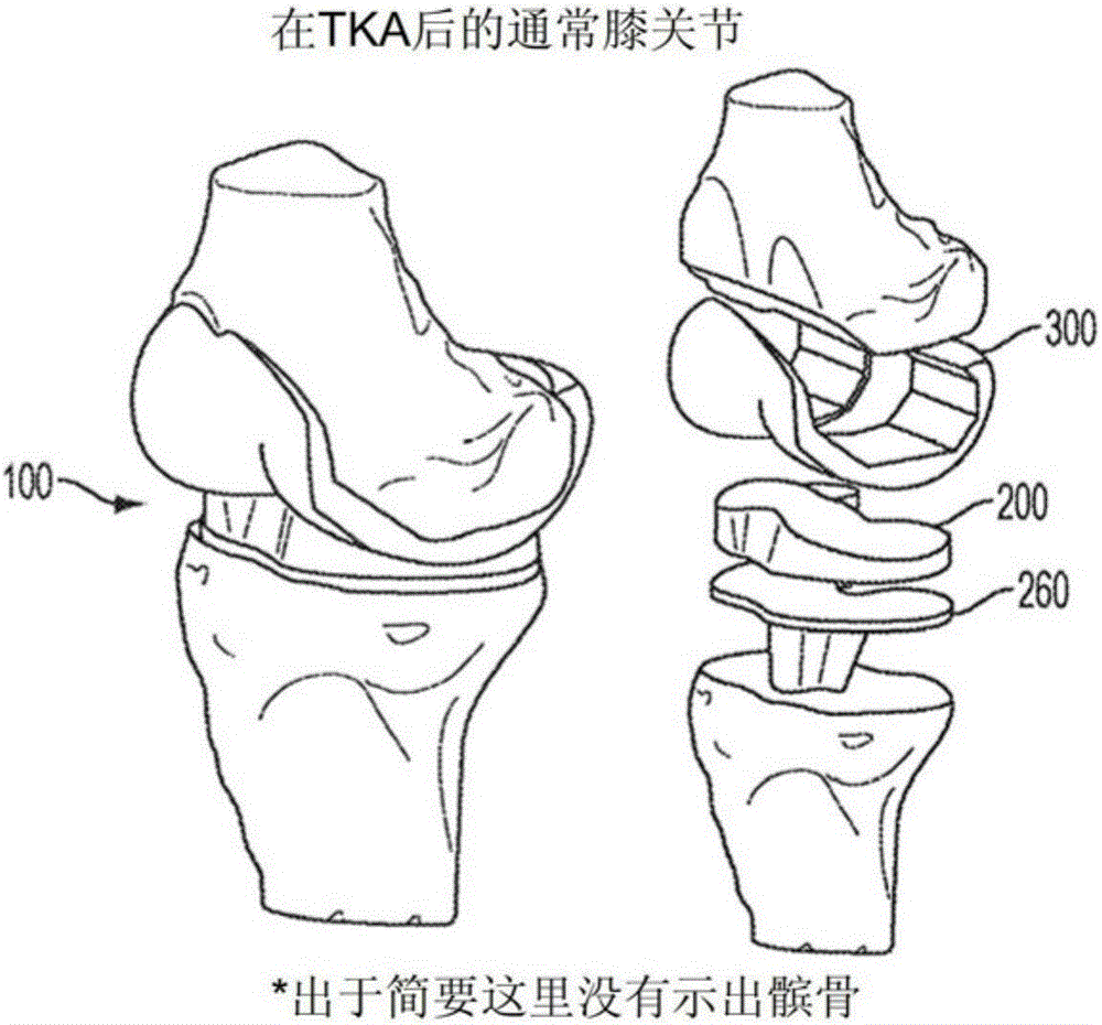 用于恢复正常弯曲范围和膝关节运动性能的植入物的制作方法与工艺