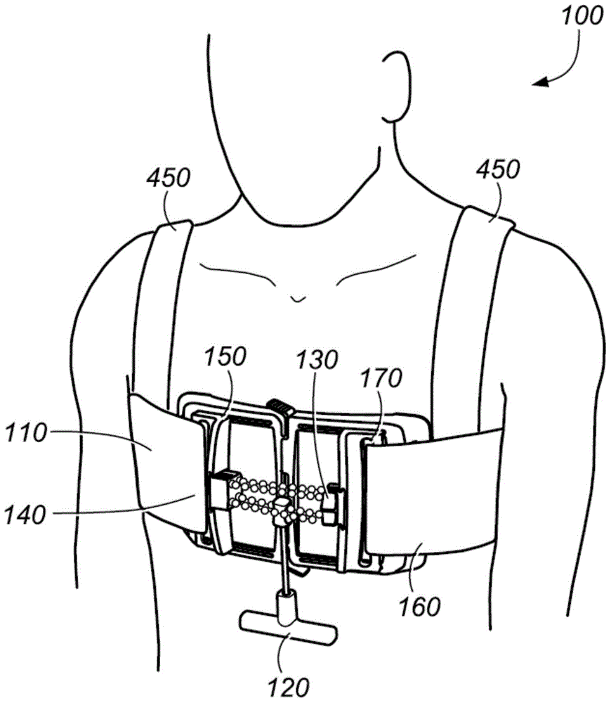 矯形裝置和限制受試者胸部的擴張的方法與流程