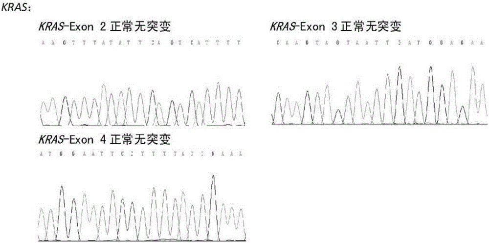 多发性骨髓瘤预后相关基因突变检测试剂盒及检测方法与流程