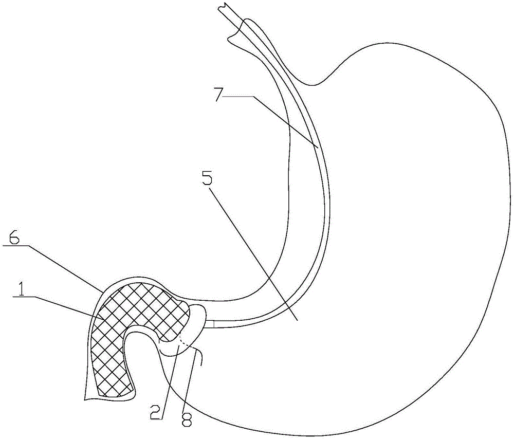 十二指肠支架以及十二指肠支架置入器的制作方法与工艺