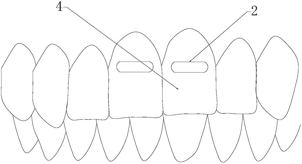 無托槽隱形矯正器的制作方法與工藝