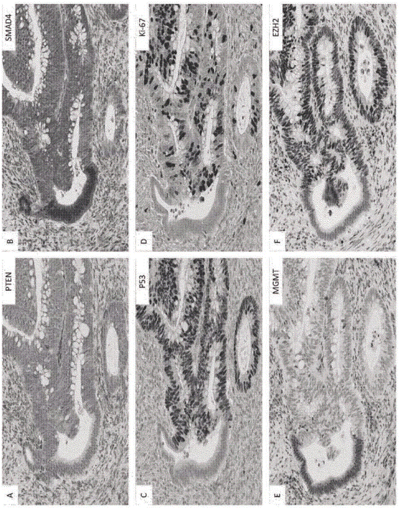 用于在癌癥中檢測腺瘤?腺癌過渡的方法和組合物與流程