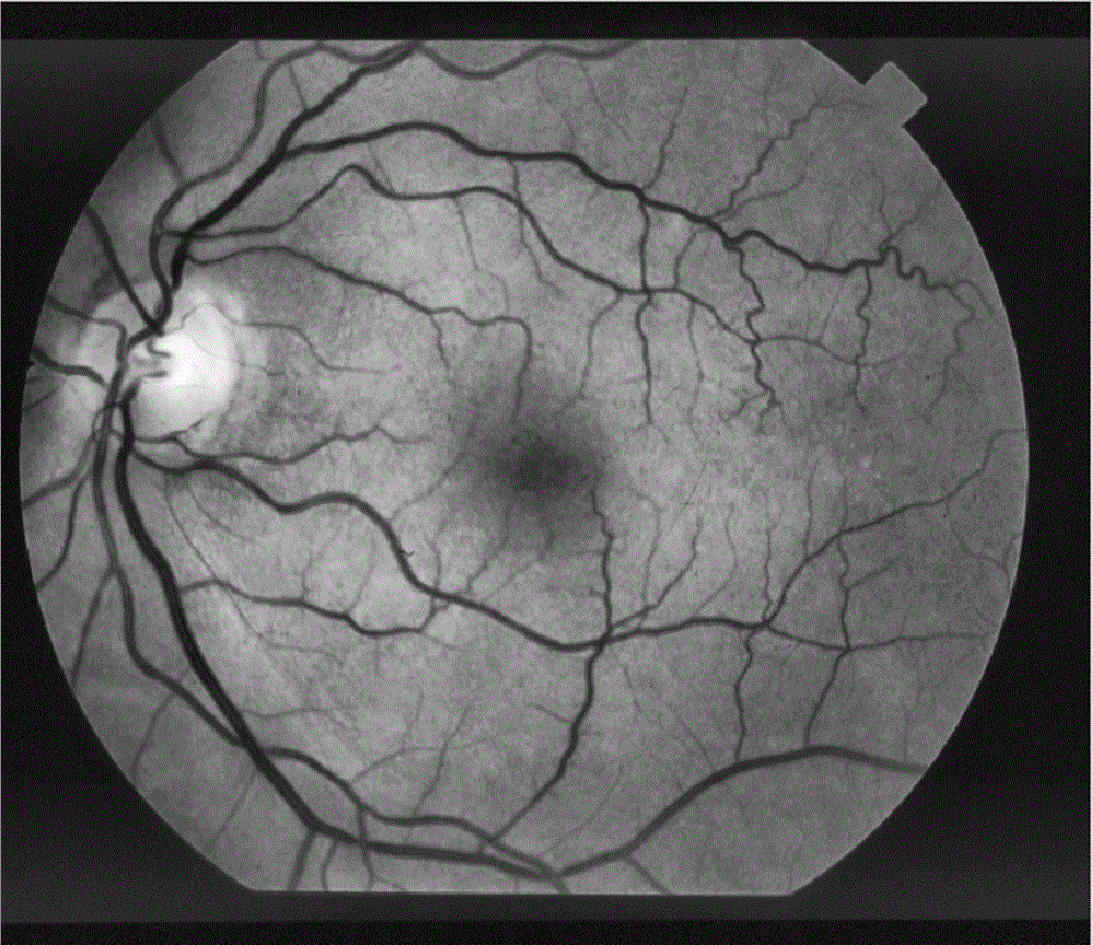 一种视网膜眼底图像预处理方法与流程