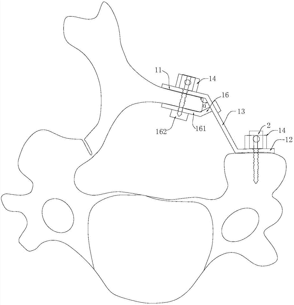 一種頸椎后路雜交手術(shù)單開門系統(tǒng)的制作方法與工藝