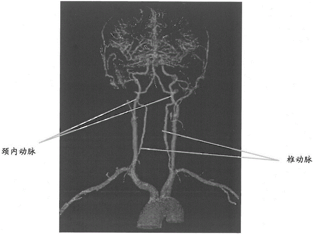 血管提取方法及其裝置與流程