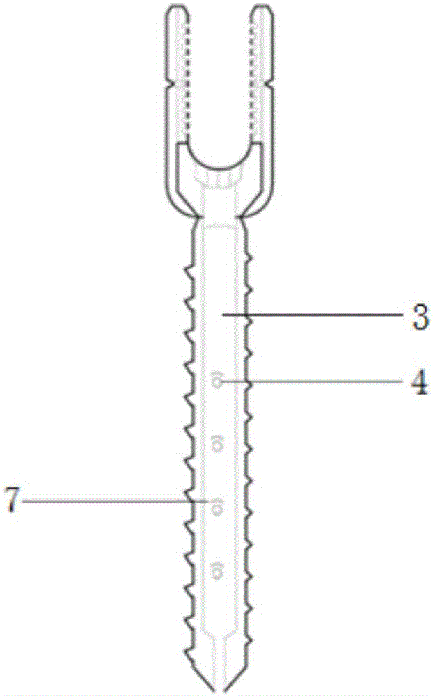 用于骨質(zhì)疏松條件下脊柱內(nèi)固定的骨質(zhì)融合椎弓根螺釘?shù)闹谱鞣椒ㄅc工藝