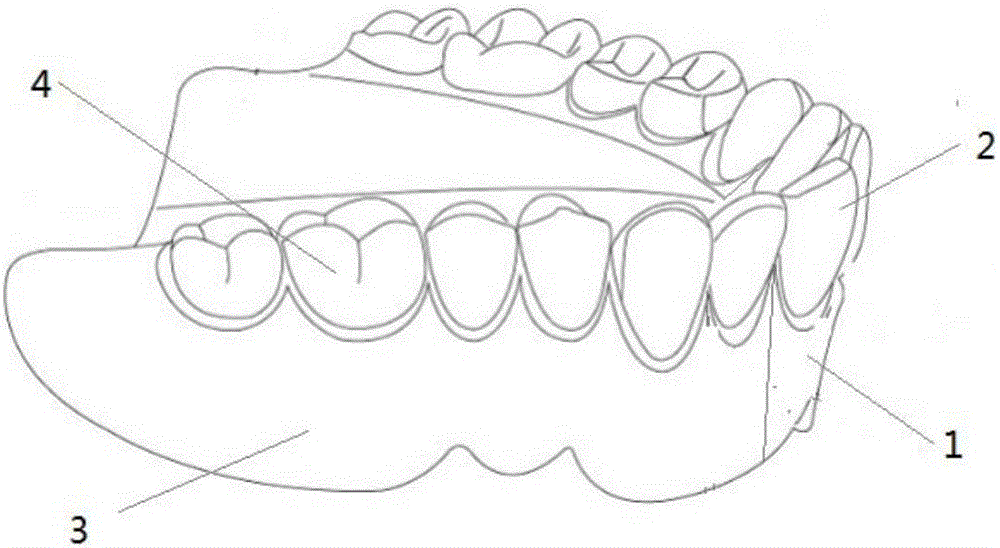分体式活动义齿的制作方法与工艺