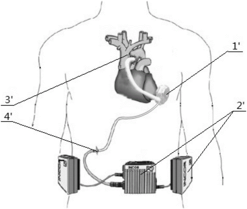 一种植入式心室辅助装置的制作方法