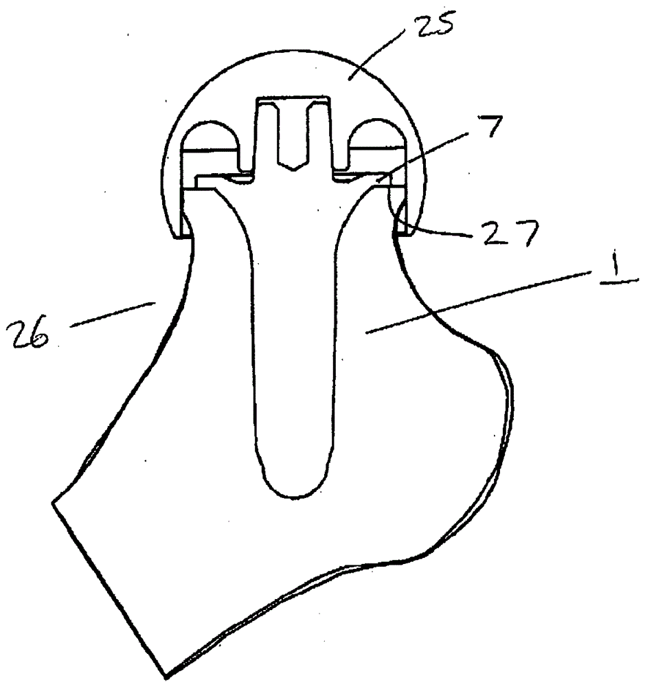 關(guān)節(jié)假體的制作方法與工藝