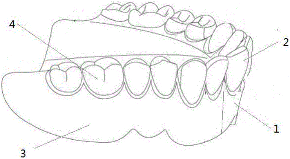 新型分体式活动义齿的制作方法与工艺