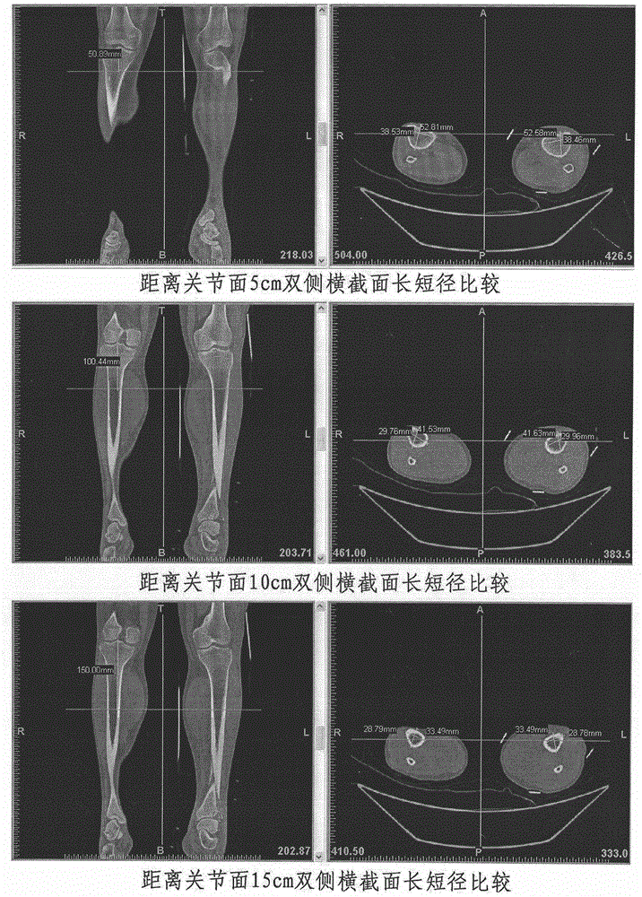 一種基于3D打印的骨折復(fù)原技術(shù)的制造方法與工藝