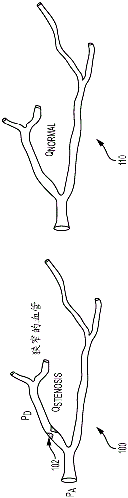 使用患病和假想正常解剖學(xué)模型中的流計算的冠狀動脈狹窄的非侵入功能評價的方法和系統(tǒng)與制造工藝