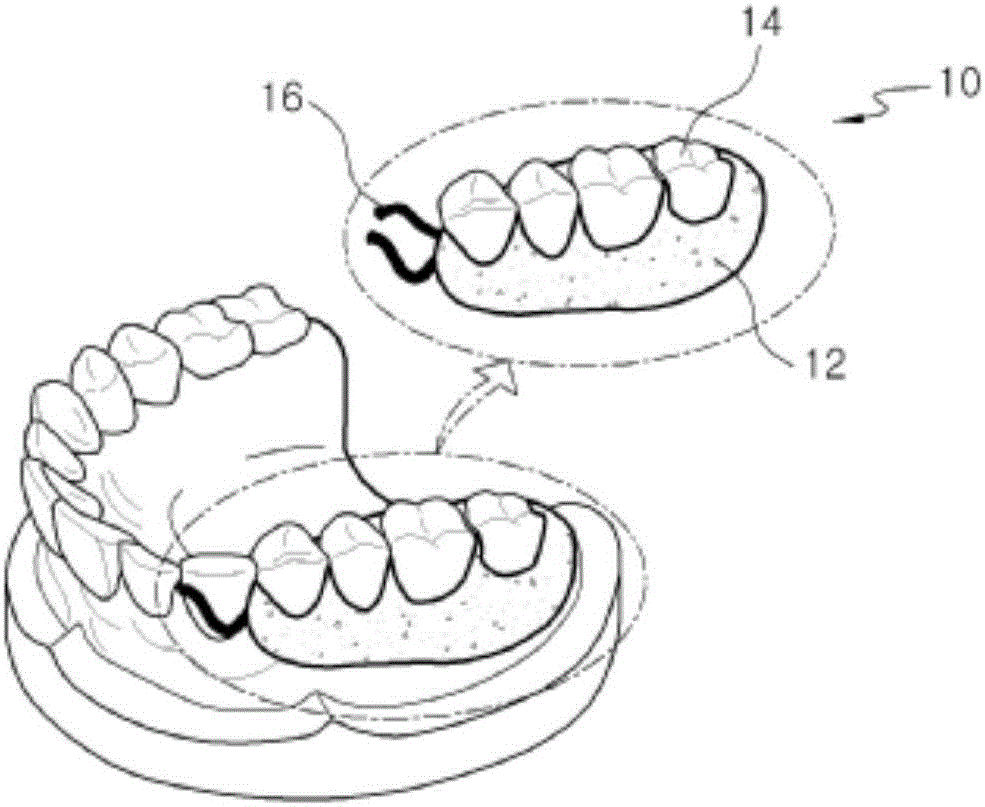 局部义齿及制造方法与流程