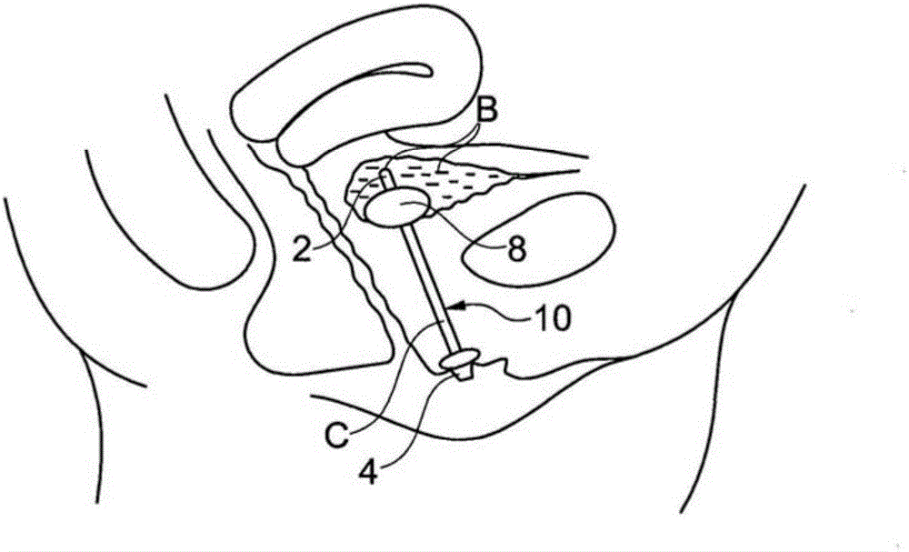 尿流控制系统和磁性致动器装置的制造方法