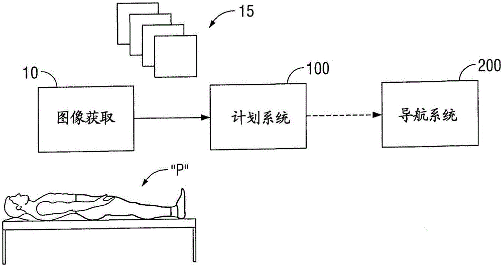 用于消融手術的計劃系統和導航系統的制造方法與工藝