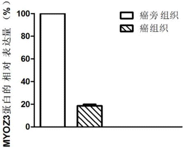 一种喉鳞癌的诊断标志物及其治疗靶标的制作方法与工艺