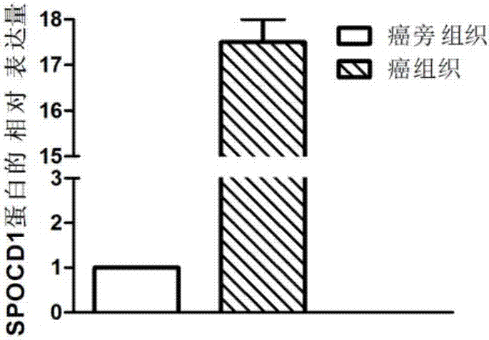 一种与喉鳞癌相关的基因及其应用的制作方法与工艺