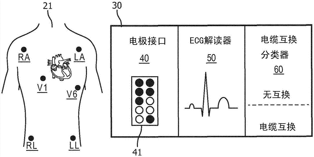 针对不同ecg导联系统的ecg电缆互换的自动检测/分类的