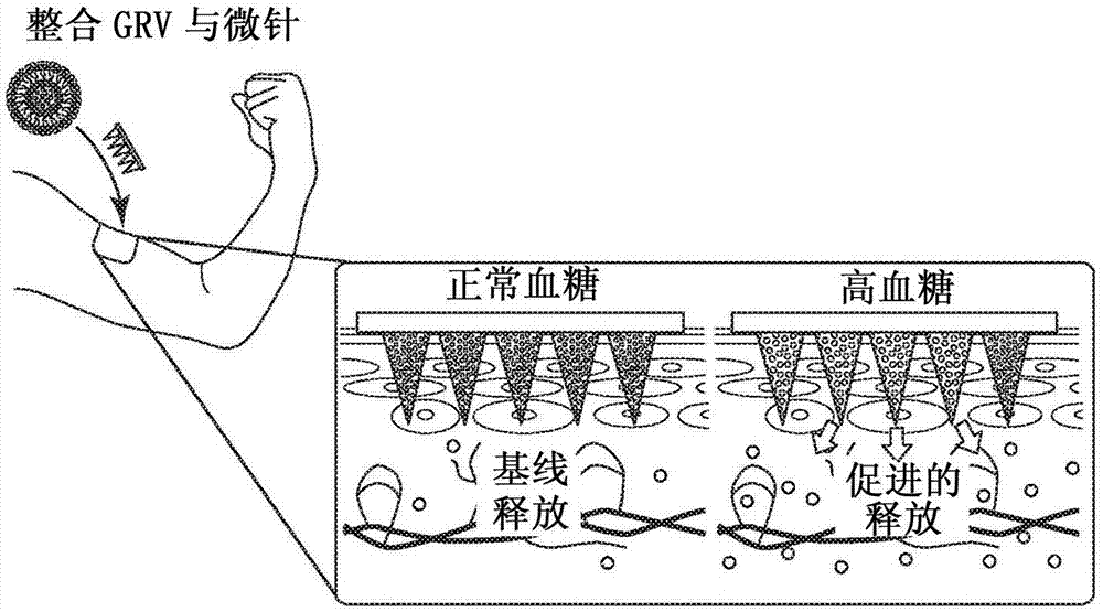 使用缺氧敏感性纳米复合材料的葡萄糖响应性胰岛素递