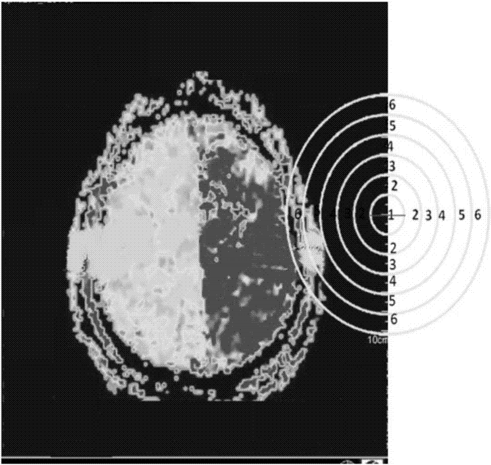 研究缺血性卒中病灶区和半暗带区病理变化的定位方法与流程