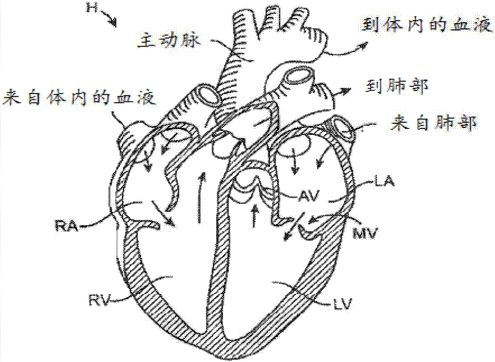 人造心瓣装置、人造二尖瓣以及相关系统和方法与流程
