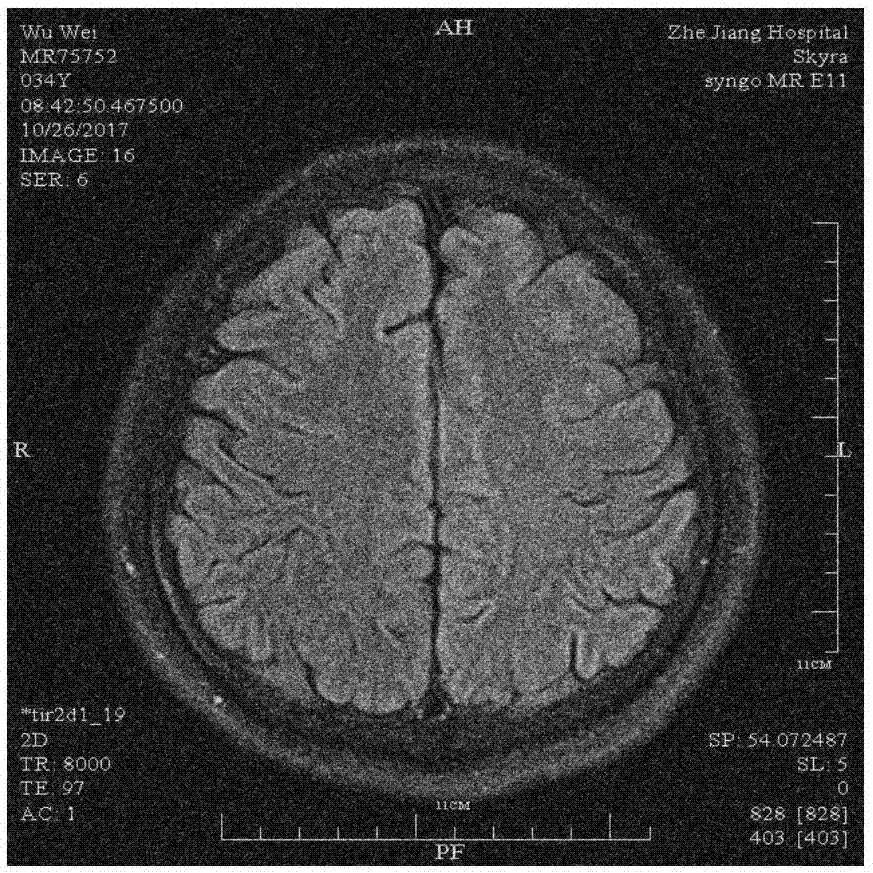 基于频域尺度平滑Shearlet的医学MRI图像去噪方法与流程