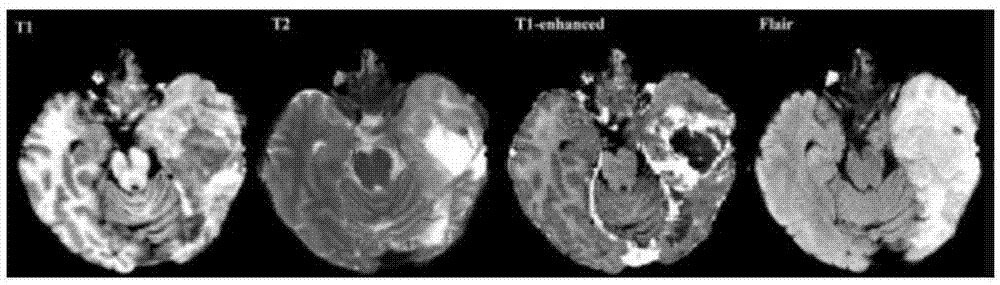 基于改进的连续型最大流算法的脑肿瘤MRI三维分割方法与流程