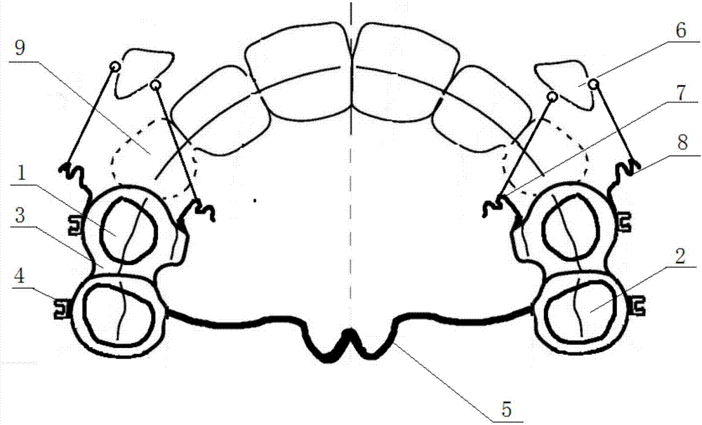 改良固定式尖牙远移器的制作方法