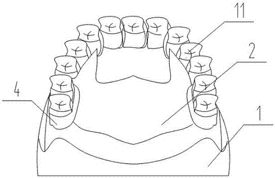 可拆卸的义齿病例模型的制作方法