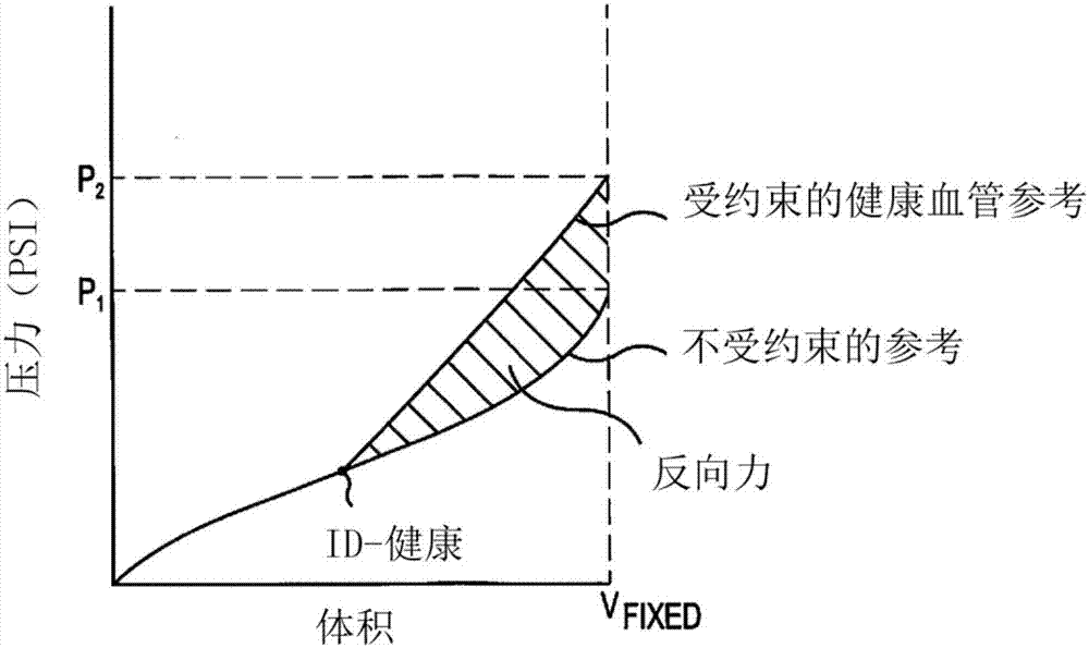 血管手术间感测、测量和/或表征血管和/或病变顺应和/或弹性变化的方法、装置和系统与流程