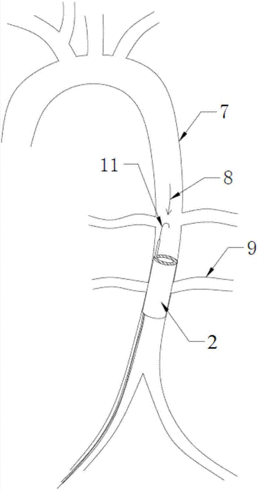 一种球囊导管的制作方法