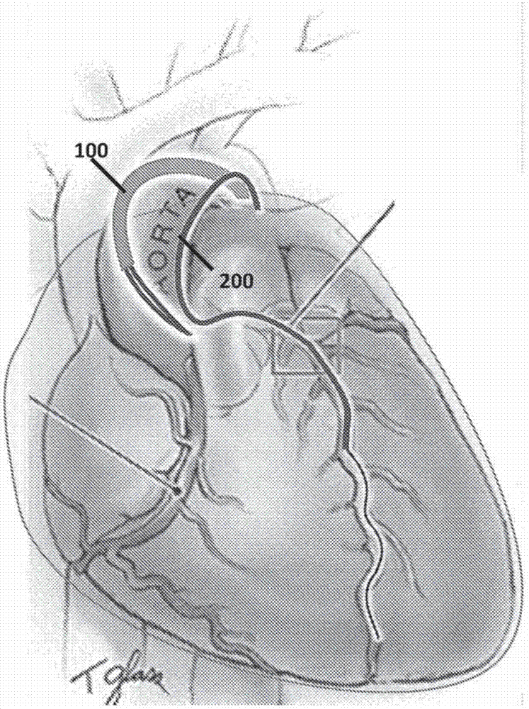 用于最小侵入性经导管冠状动脉旁通植入的方法与装置与流程