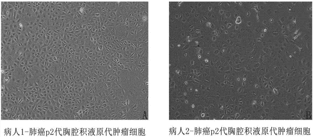 一种利用恶性胸腔积液分离培养原代肿瘤细胞的方法与流程