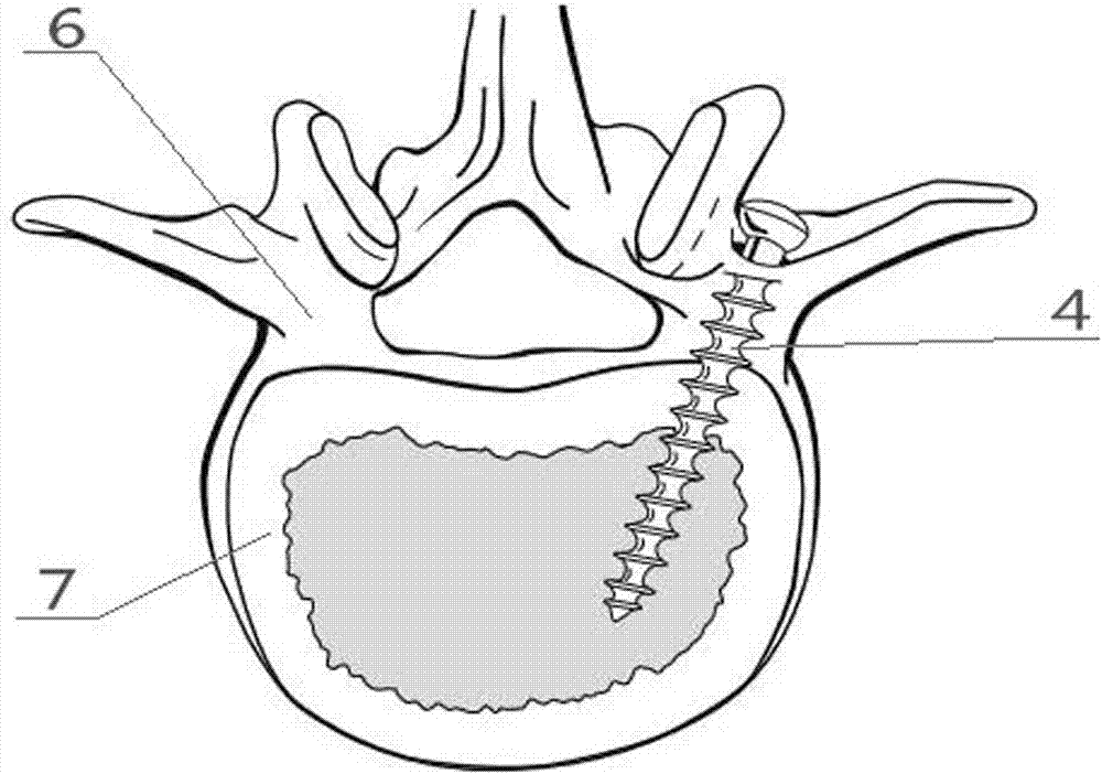 一种脊柱椎弓根置钉软组织保护装置的制作方法