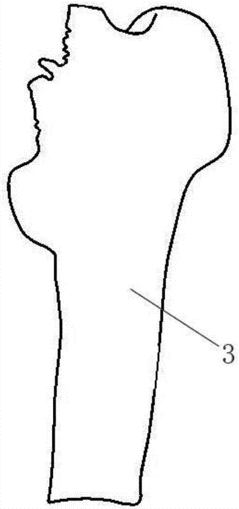个性化股骨柄假体植入前倾角导向装置的制作方法