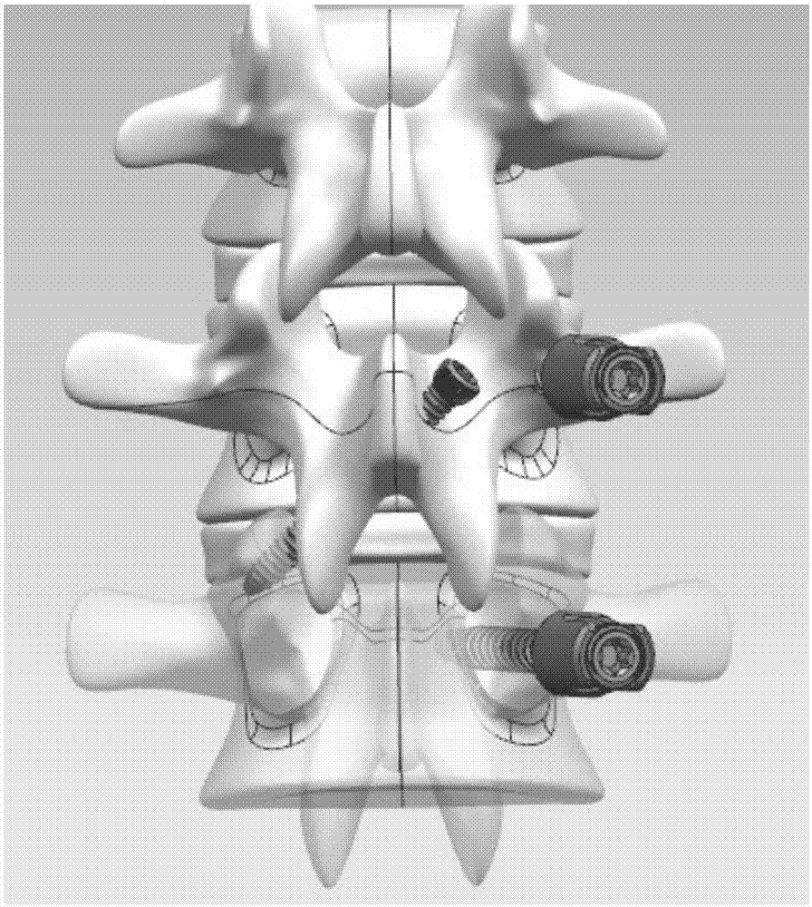 一种腰椎经关节螺钉连接器的制作方法