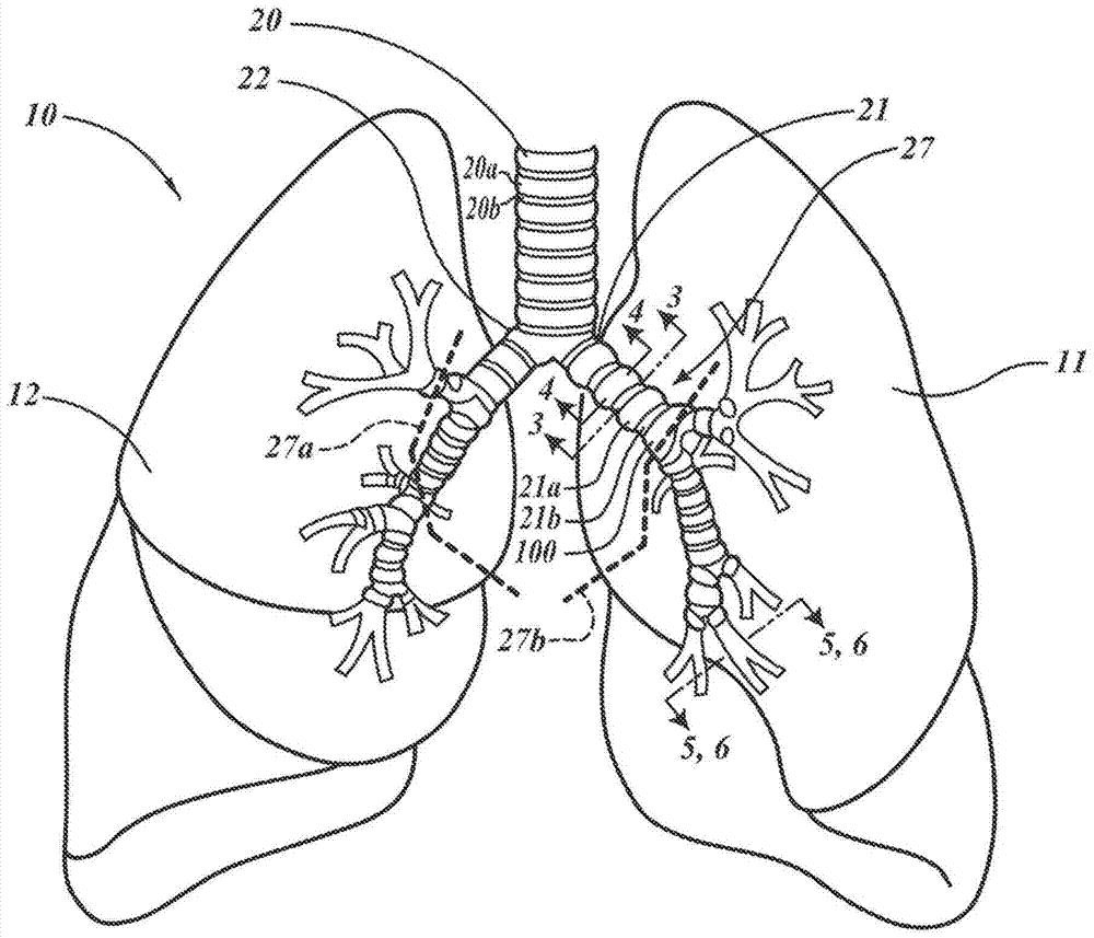 紧凑传送的肺部治疗系统和改善肺部功能的方法与流程