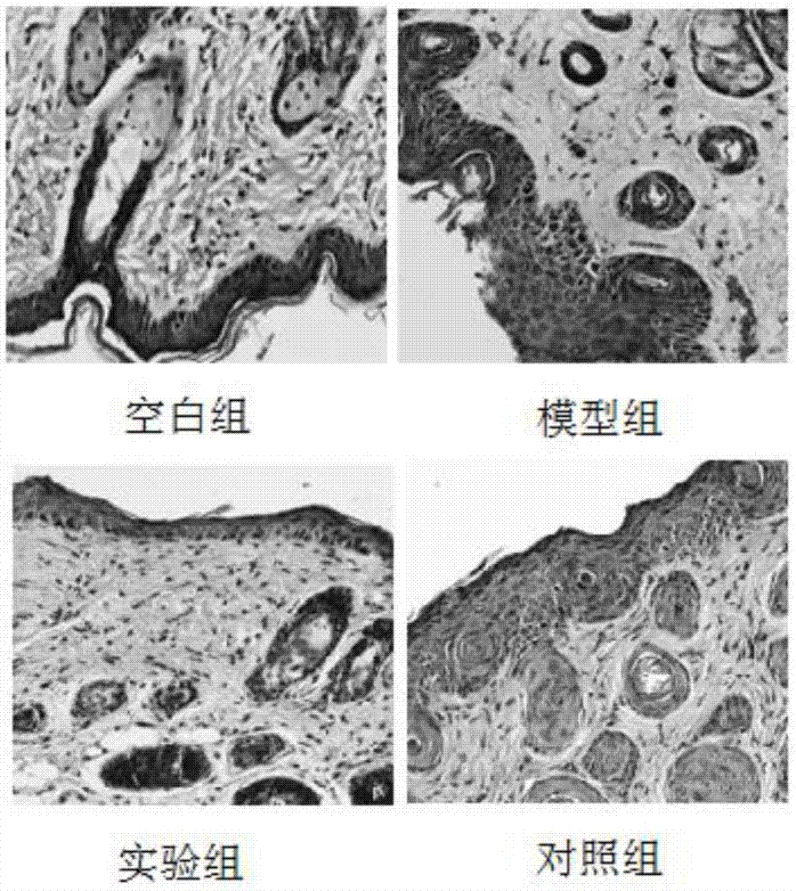 一种用于缓解银屑病的敷料及制备方法与流程