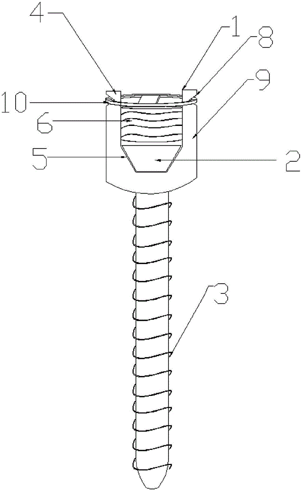 一种扣环锁定抗旋转滑动型脊柱椎弓根钉系统的制作方法